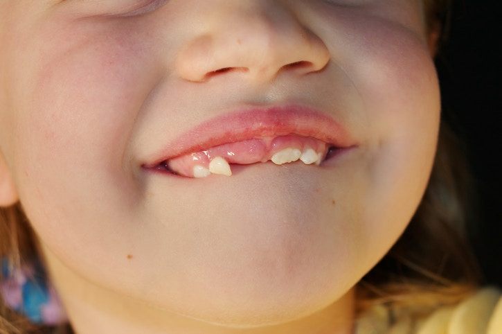 Little girl smiling showing her lost tooth.